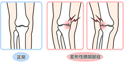 変形性膝関節症の代表的な疾患の治療法イメージ