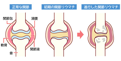 関節リウマチイメージ